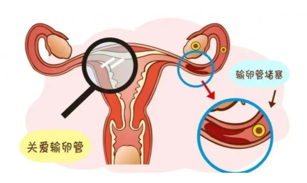 怎样才能知道是不是输卵管堵塞？这些医学检查帮你准确诊断