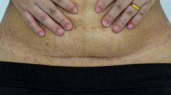 <b>瘢痕子宫可以生二胎吗？安全不？</b>