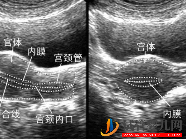 子宫厚度正常厚度8值12mm之间