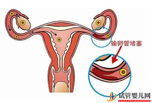 美国试管婴儿如何助孕输卵管性不孕（试管婴儿多少钱）(图1)