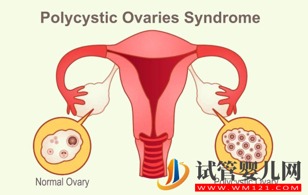 多囊卵巢可用多吃药物治疗