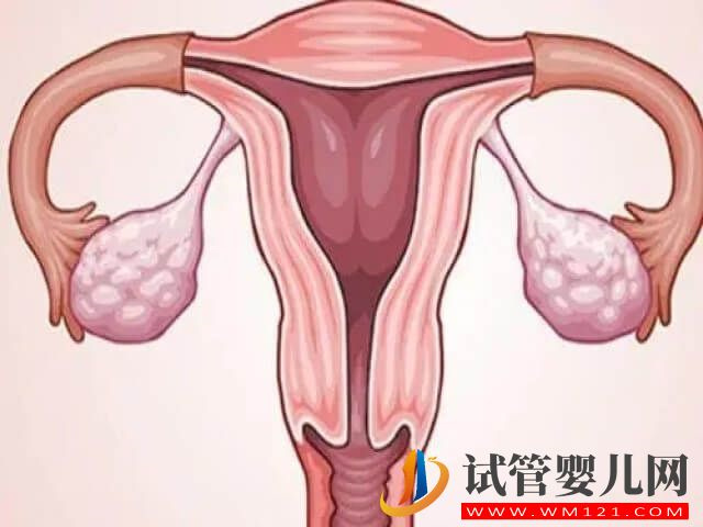 子宫疤痕憩室做试管不一定能一次成功