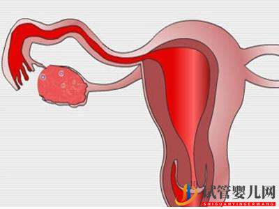 试管婴儿网:子宫肌瘤做俄罗斯试管婴儿的成功率高吗？(图2)