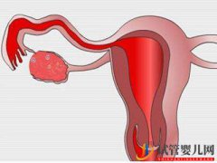 <b>子宫肌瘤做俄罗斯试管婴儿的成功率高吗？</b>