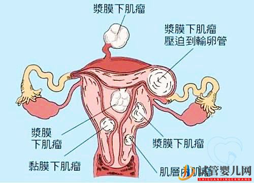 多发性子宫肌瘤可以做试管婴儿吗？你都了解吗(图1)