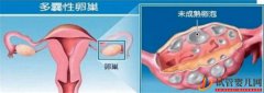 多囊卵巢综合征对试管婴儿成功率有哪些影响_如