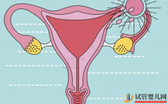双侧卵巢多囊能怀孕吗 双侧卵巢多囊原因是什么